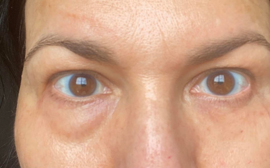 No more Undereye Puffiness…Ever!